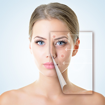 anti-acne